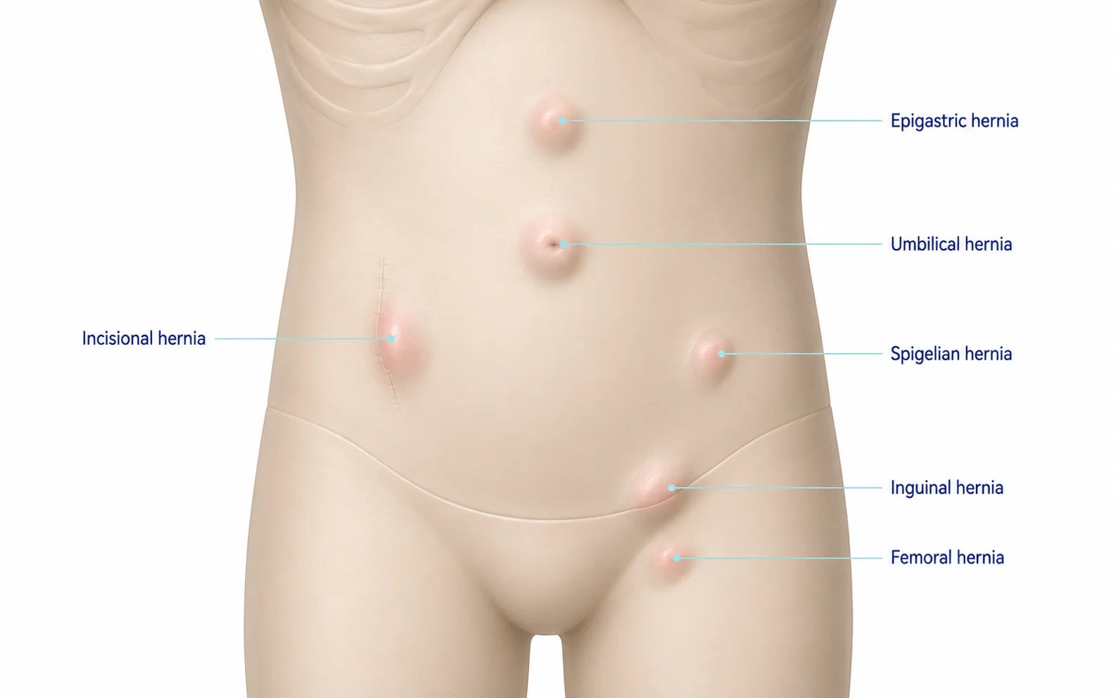 Hernias