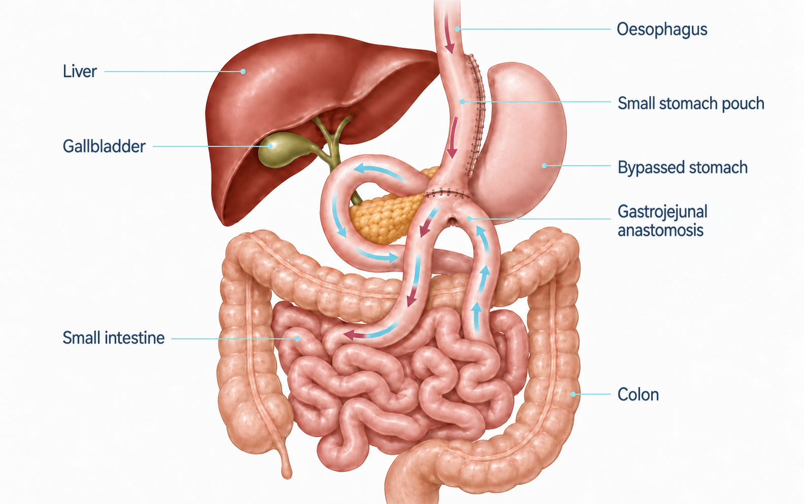 Laparoscopic One Anastomosis Gastric Bypass - FINAL